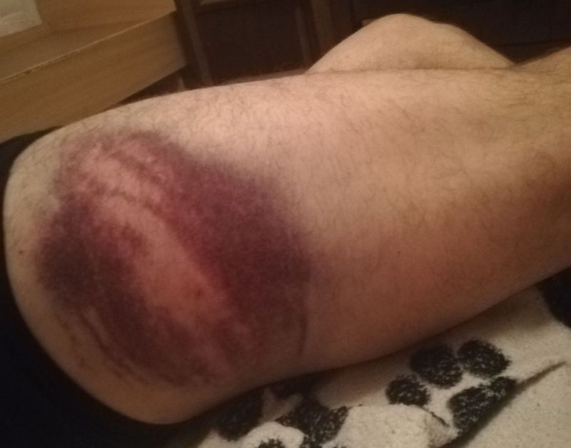 Bruises on the victim's leg