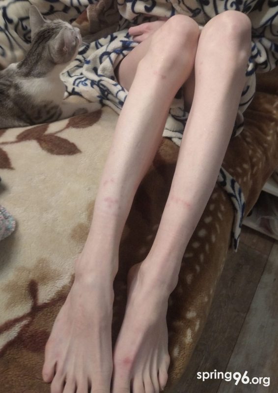 Ноги Татьяны Батуро после 46 суток за решеткой