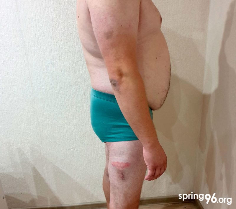 Bruises on the victim's body