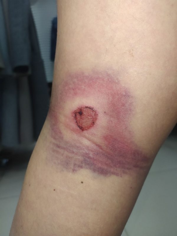 The victim's leg injured by a rubber bullet